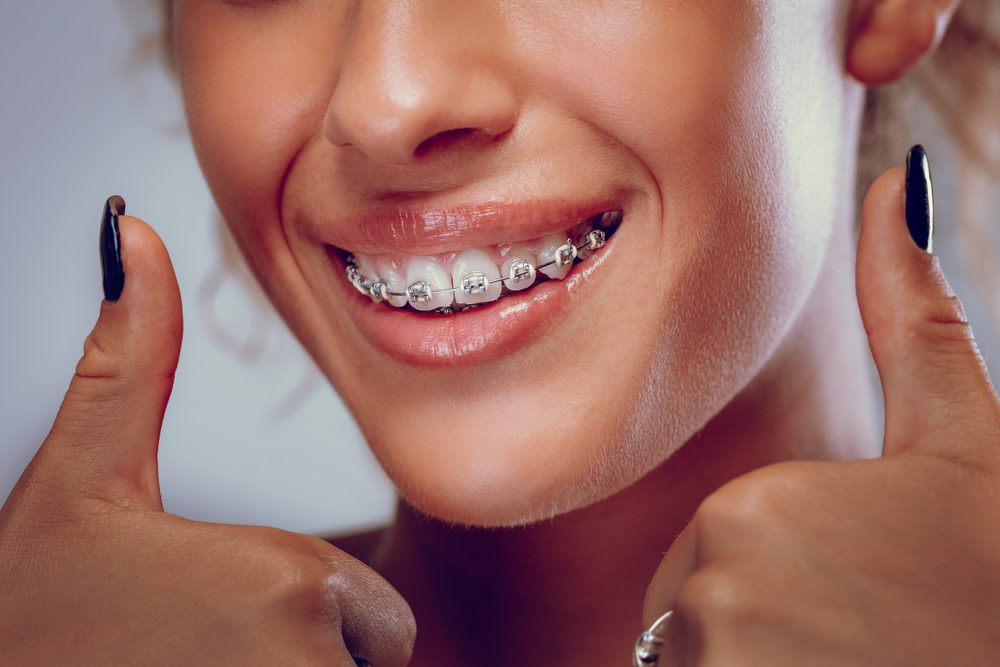Close-up of a woman's white teeth with braces and smile.