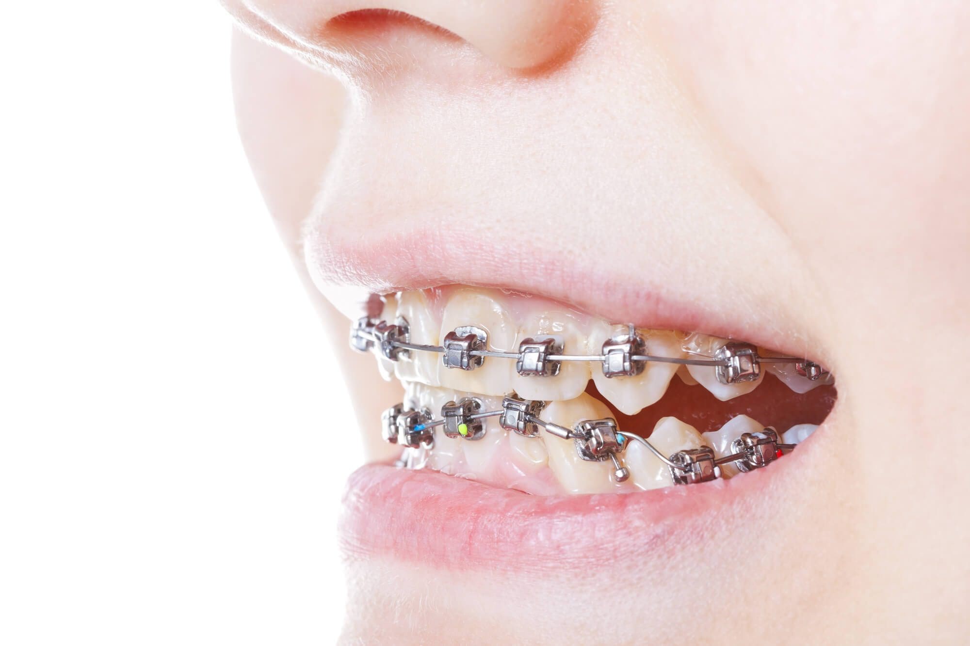 Underbite